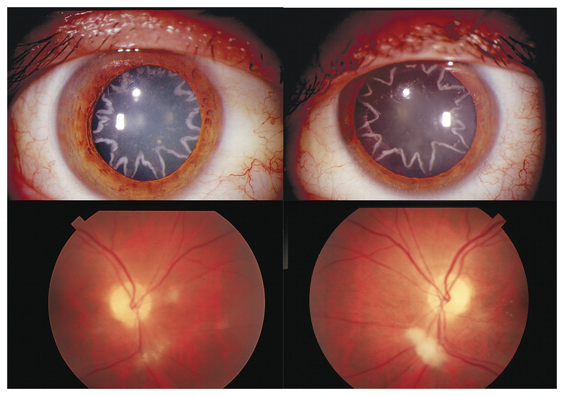 Illustration for article titled A 14,000-volt electrical shock gave this man star-shaped cataracts